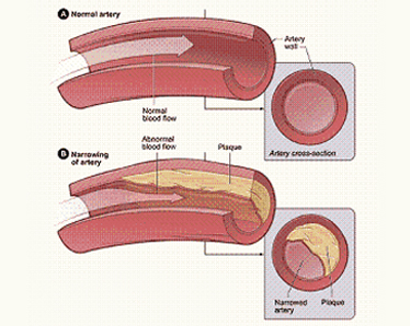 coronary-artery-disease-1